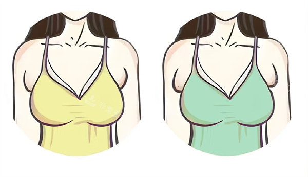 副乳图片