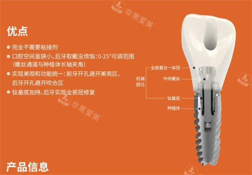 百齿泰植体优势有哪些