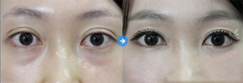 #2Y*&x*b醫(yī)院雙眼皮手術(shù)