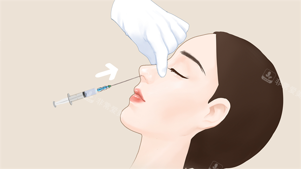 玻尿酸隆鼻术