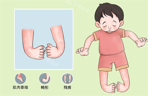 馬蹄足內(nèi)翻卡通圖