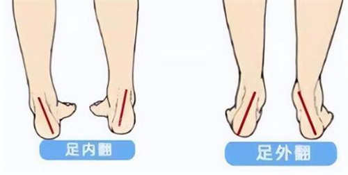 馬蹄足內(nèi)翻與外翻照片