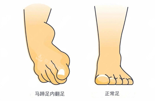 馬蹄足內(nèi)翻和正常足區(qū)別卡通