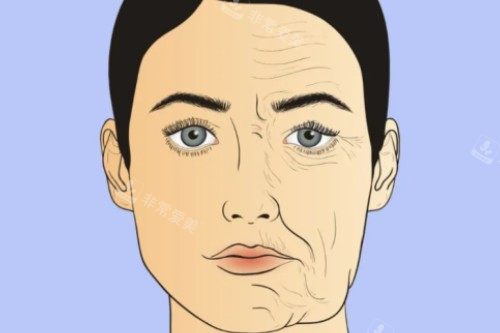 面部衰老提升卡通对比图