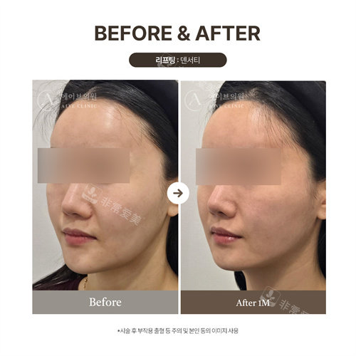 韓國aive皮膚科面部提升前后對比