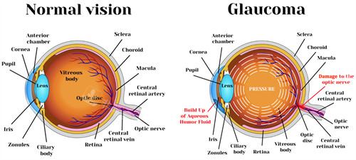 正常眼睛和青光眼的对比图