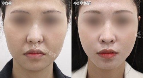 韩国selfi整形外科面部提升正面对比 韩国selfi整形外科面部提升正面对比