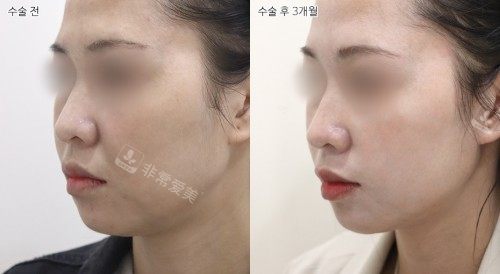 韩国selfi整形外科面部提升侧面对比 韩国selfi整形外科面部提升侧面对比