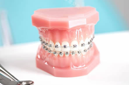 京州口腔凯里分院牙齿矫正价格分析 京州口腔凯里分院牙齿矫正价格分析