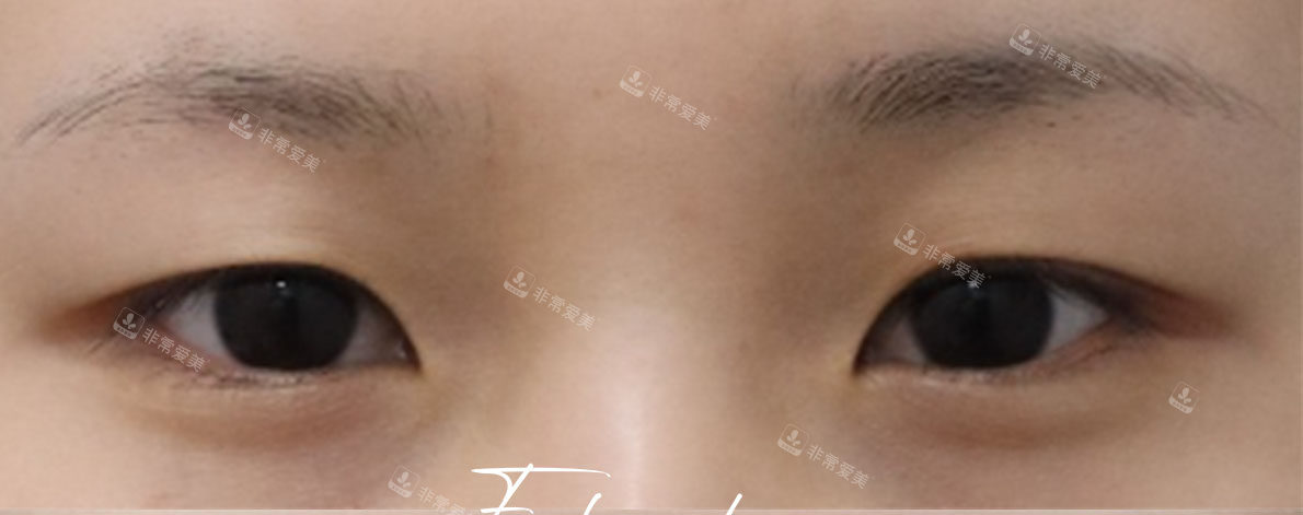 清潭es整形外科双眼皮前 清潭es整形外科双眼皮前