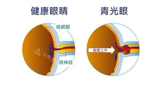 正产眼对比青光眼展示图 正产眼对比青光眼展示图