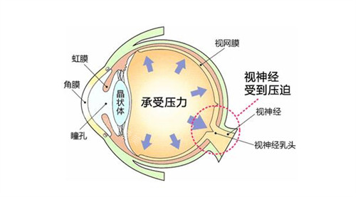 眼压高的因素分享展示 眼压高的因素分享展示