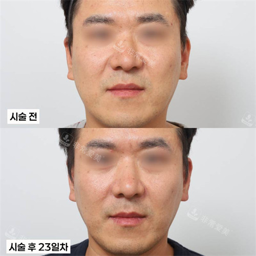 韩国新整形外科玻尿酸填充 韩国新整形外科玻尿酸填充