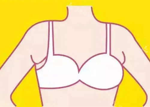 副乳位置卡通示意圖 (2) 副乳位置卡通示意圖 (2)