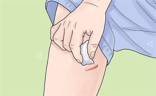 疤痕疙瘩怎么护理 疤痕疙瘩怎么护理