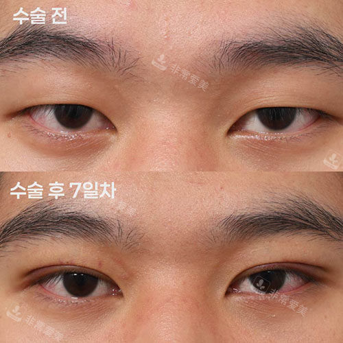 男士双眼皮前后对比照片 男士双眼皮前后对比照片