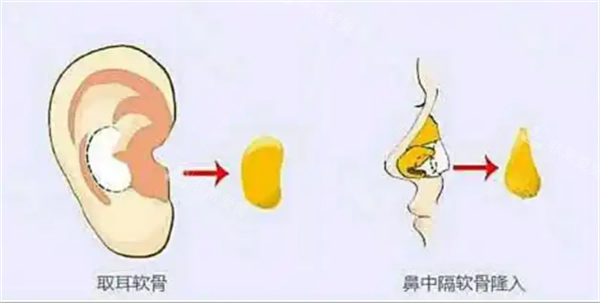 耳软骨隆鼻