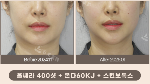 韩国梅宗德皮肤科下颌线改善对比 韩国梅宗德皮肤科下颌线改善对比