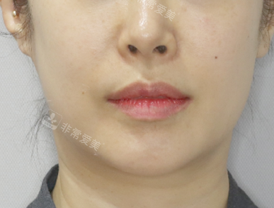 肤科下颌线改善前 肤科下颌线改善前