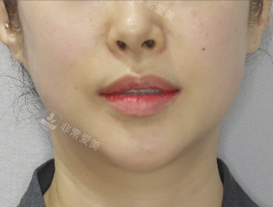 肤科下颌线改善后 肤科下颌线改善后