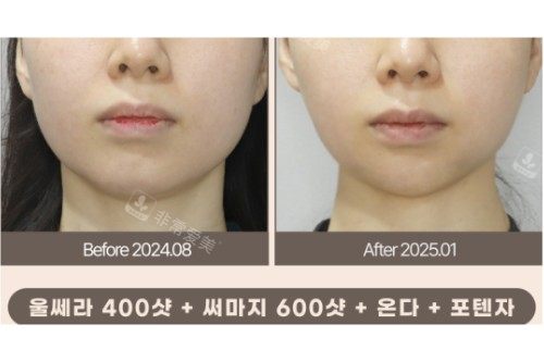 梅宗德皮肤科前后对比 梅宗德皮肤科前后对比