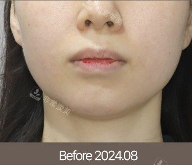 梅宗德皮肤科术前图 梅宗德皮肤科术前图