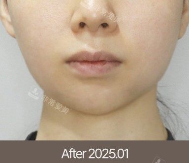 梅宗德皮肤科术后图 梅宗德皮肤科术后图