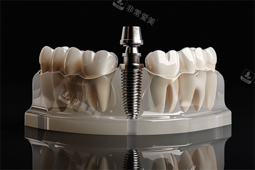 種植牙植體漫畫示意圖