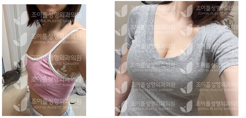 韩国喜悦整形外科隆胸前后对比