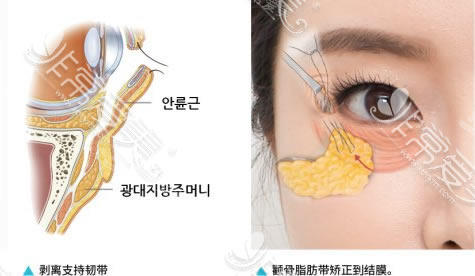 加减美整形面部除皱特点分析 加减美整形面部除皱特点分析