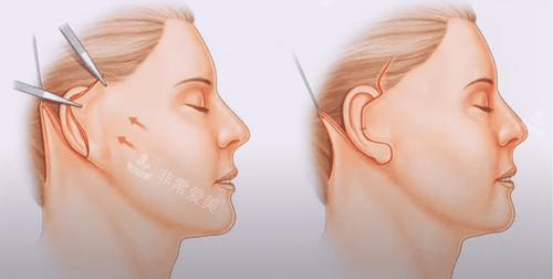 北京加减美v9手术优势提拉量大作用明显 北京加减美v9手术优势提拉量大作用明显