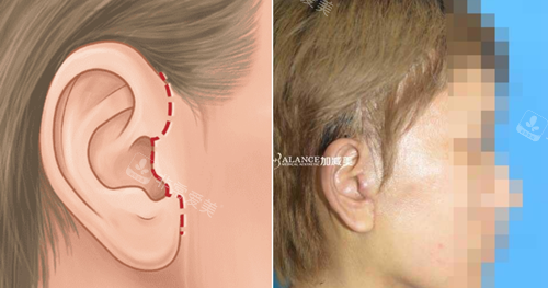 北京加减美v9手术优势不留疤痕 北京加减美v9手术优势不留疤痕