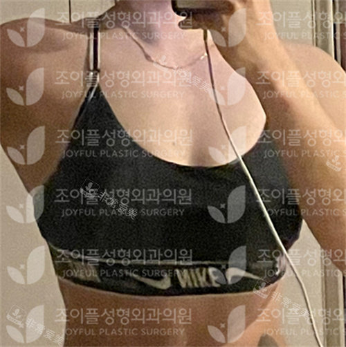 韓國喜悅整形隆胸手術(shù)前照片 韓國喜悅整形隆胸手術(shù)前照片