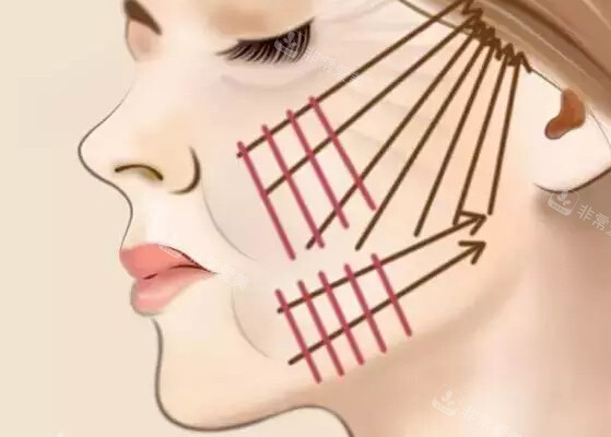 面部埋線提升 面部埋線提升