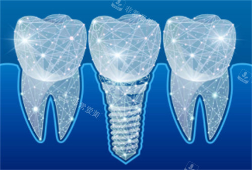 种植牙科技感卡通