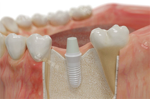 德国SKY种植牙植入模拟图