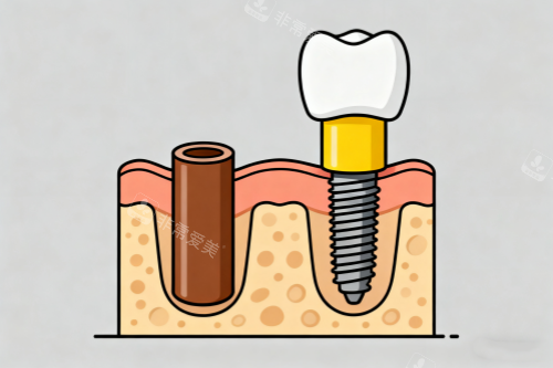 单颗种植牙卡通图展示