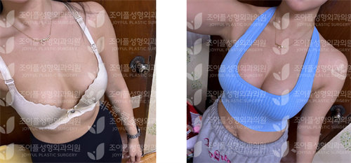 韩国喜悦整形的胸部整形 韩国喜悦整形的胸部整形