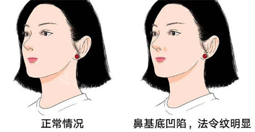 鼻基底凹陷和正常的对比