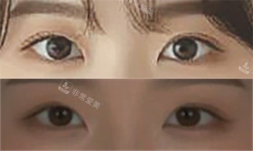 韩国the swan整形外科内眼角前后对比