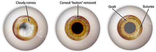 角膜移植动画图