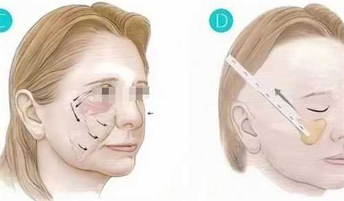 微拉美先提升流程图