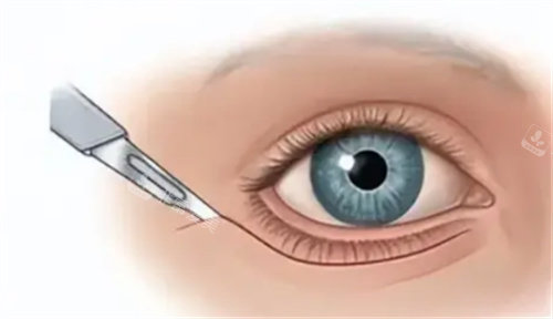眼周筋膜提升切口