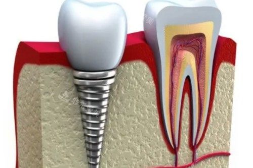 种植牙植入模型图