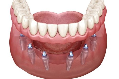 all-on-6种植卡通图