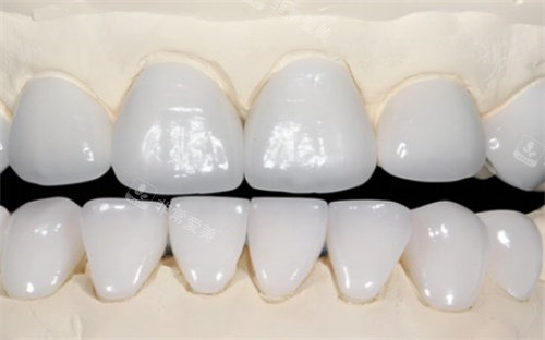 全口全瓷牙