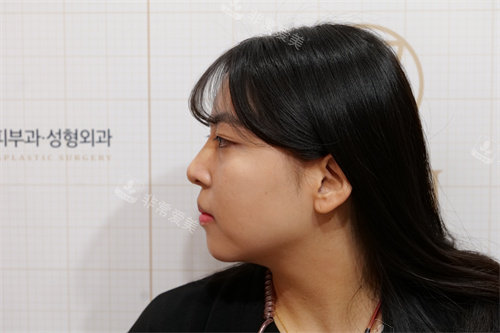 韩国jryn皮肤科釜山西面店鼻子玻尿酸术后侧面照片