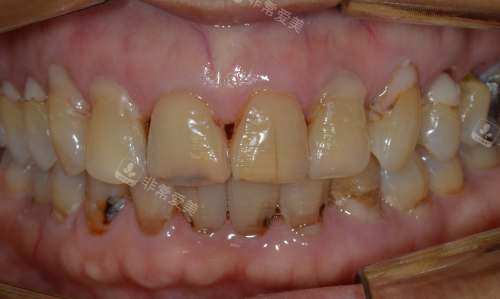 韩国NewYorkWhite牙科牙齿修复前