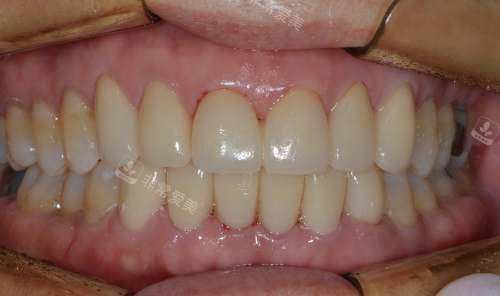 韩国NewYorkWhite牙科牙齿修复后