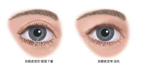 什么情况下要提眉